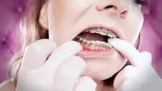 Riproduci Asmr: apparecchi migliorati con elastici a maglia di catena e guanti in nitrile (arya grander)