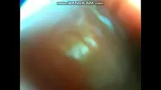 Play Diy endotelescope strivees ileoblind gut valve.